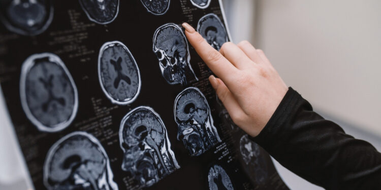 Απότομη αύξηση του σακχάρου στο αίμα συνδέεται με υψηλότερο κίνδυνο Αλτσχάιμερ