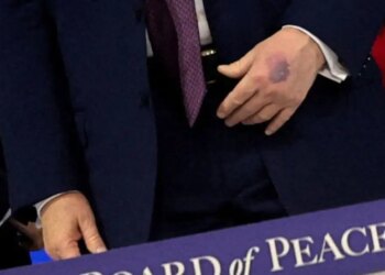 Η εξήγηση Ντόναλντ Τραμπ για τη νέα μελανιά στο χέρι του: «Το χτύπησα στο τραπέζι, είναι παρενέργεια της ασπιρίνης»