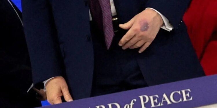 Η εξήγηση Ντόναλντ Τραμπ για τη νέα μελανιά στο χέρι του: «Το χτύπησα στο τραπέζι, είναι παρενέργεια της ασπιρίνης»