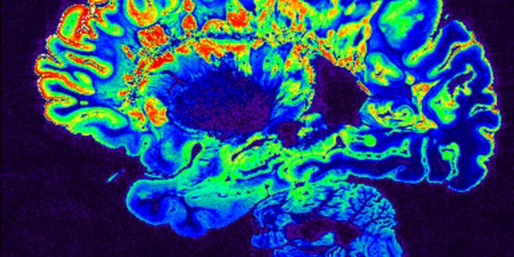 Σκλήρυνση κατά πλάκας: Μπορεί να ξεκινά πάνω από 10 χρόνια πριν τα συμπτώματα