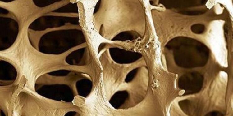 Πώς η άσκηση προστατεύει τα οστά από την οστεοπόρωση