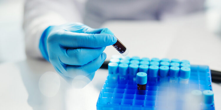 Αλτσχάιμερ: Νέο τεστ αίματος «μετράει» πότε θα χτυπήσουν τα πρώτα συμπτώματα