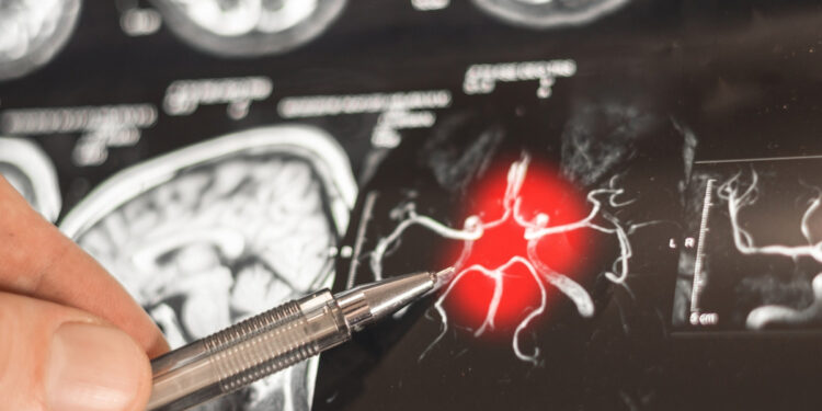 Εργαλείο AI προβλέπει το Αλτσχάιμερ με ακρίβεια 93%