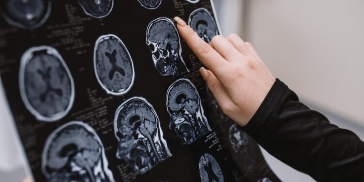 Εγκεφαλικό: Πόσο σας επηρεάζει το οικογενειακό ιστορικό