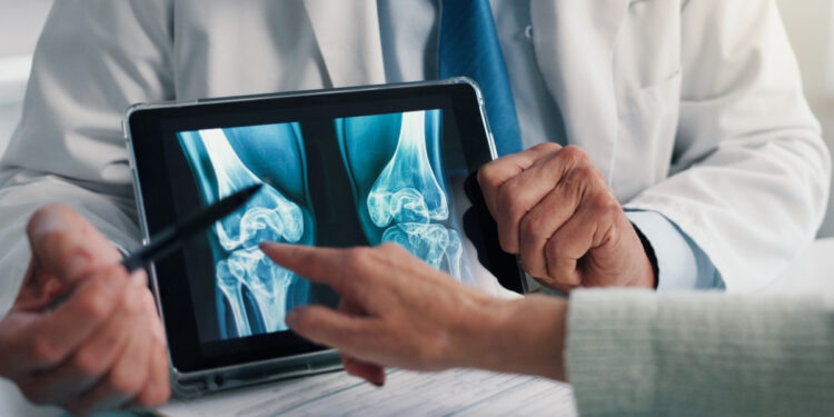 Ανησυχείτε για την οστεοπόρωση; Τι μπορεί να σας βοηθήσει πέρα από τη φαρμακευτική αγωγή