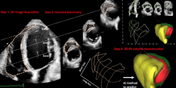 Πρωτοποριακή μέθοδος Ελλήνων επιστημόνων ανιχνεύει καρδιακά προβλήματα