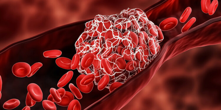 Θρόμβωση: 7 σιωπηλά συμπτώματα που πρέπει να προσέξετε