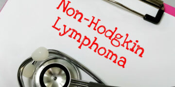 Μη-Hodgkin λέμφωμα: Η μάχη που σήμερα κερδίζεται όλο και συχνότερα – Οι νέες θεραπείες αλλάζουν τις προοπτικές ζωής χιλιάδων ασθενών