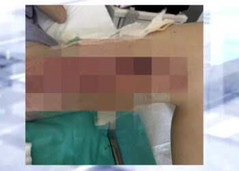 Θεσσαλονίκη: Σε εφιάλτη για 20χρονη εξελίχθηκε μία απλή επέμβαση κύστης κόκκυγα – Υπέστη εγκαύματα 3ου βαθμού
