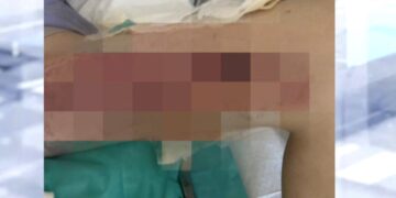 Θεσσαλονίκη: Σε εφιάλτη για 20χρονη εξελίχθηκε μία απλή επέμβαση κύστης κόκκυγα – Υπέστη εγκαύματα 3ου βαθμού
