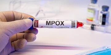 Mpox: Ο ιός εξαπλώνεται σε νέες χώρες – Πώς μπορεί να περιοριστεί η νέα έξαρση