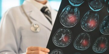 Η πρόωρη γέννηση διακόπτει την ωρίμανση του εγκεφάλου, διαπιστώνει έρευνα με επικεφαλής Έλληνες επιστήμονες